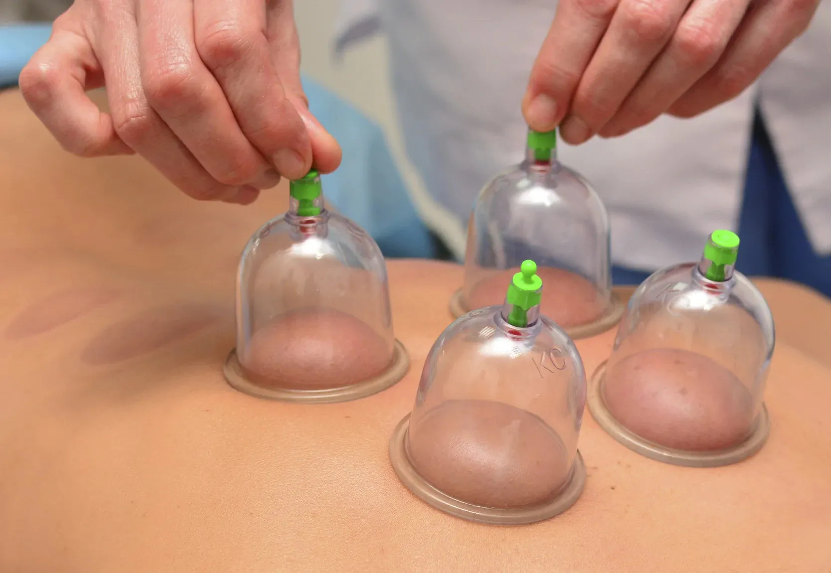 LIVE IN-PERSON 12 CE Hour Orthopedic Cupping