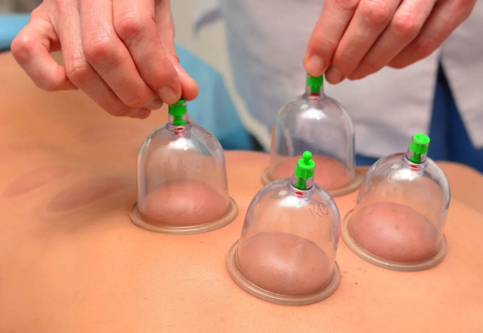 LIVE IN-PERSON 12 CE Hour Orthopedic Cupping